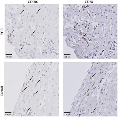 Altered Levels of Decidual Immune Cell Subsets in Fetal Growth Restriction, Stillbirth, and Placental Pathology